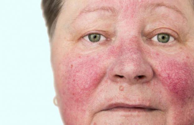 Rosacea, pimples and melasma, let's take care of it inside?