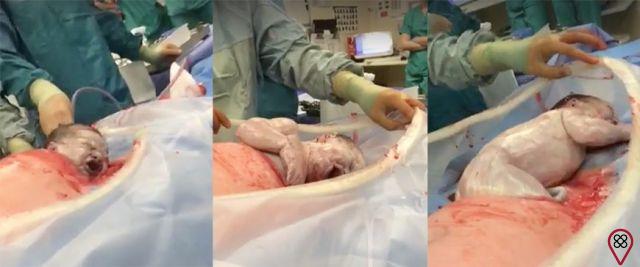 Natural cesarean section: a new type of delivery