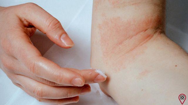 Eczema in Adults: The Cure Is in Your Behavior