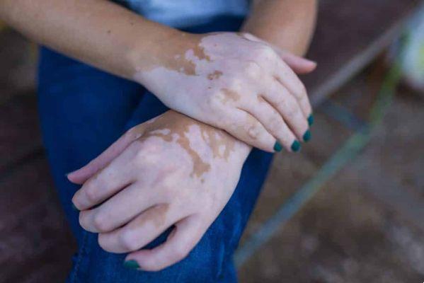 Emotional causes of Vitiligo