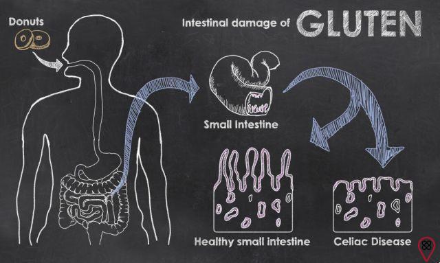Conozca los 5 signos de intolerancia al gluten