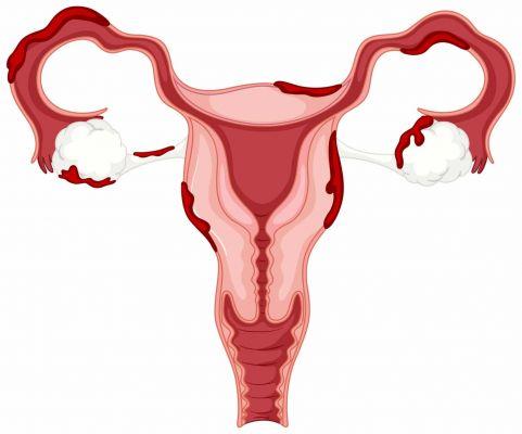 Síntomas de la endometriosis que no se pueden ignorar