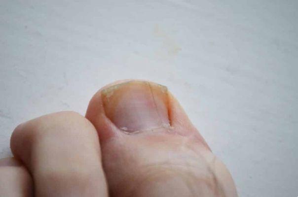 What is the relationship between your ingrown toenail and your problems?