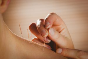 Acupuncture contre la fibromyalgie