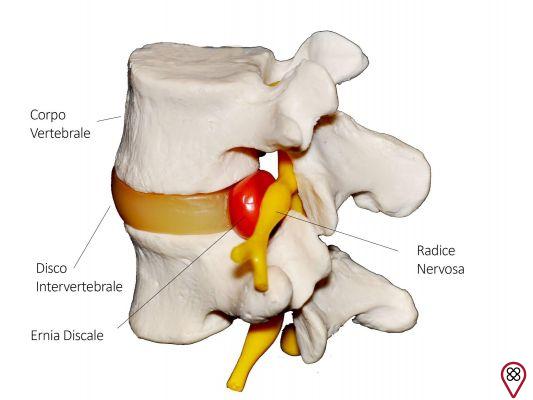Herniated disc: Are indecisions tormenting you?